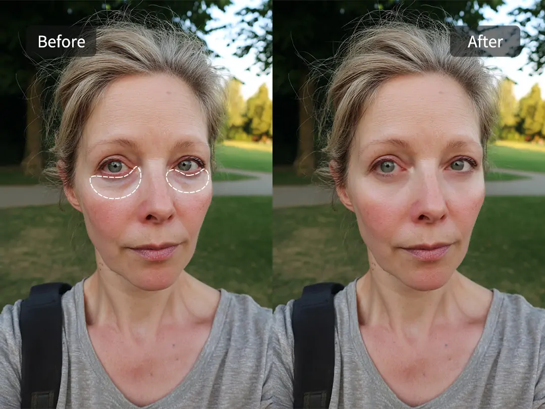 Pokecut can remove circles under eyes naturally while keeping skin texture