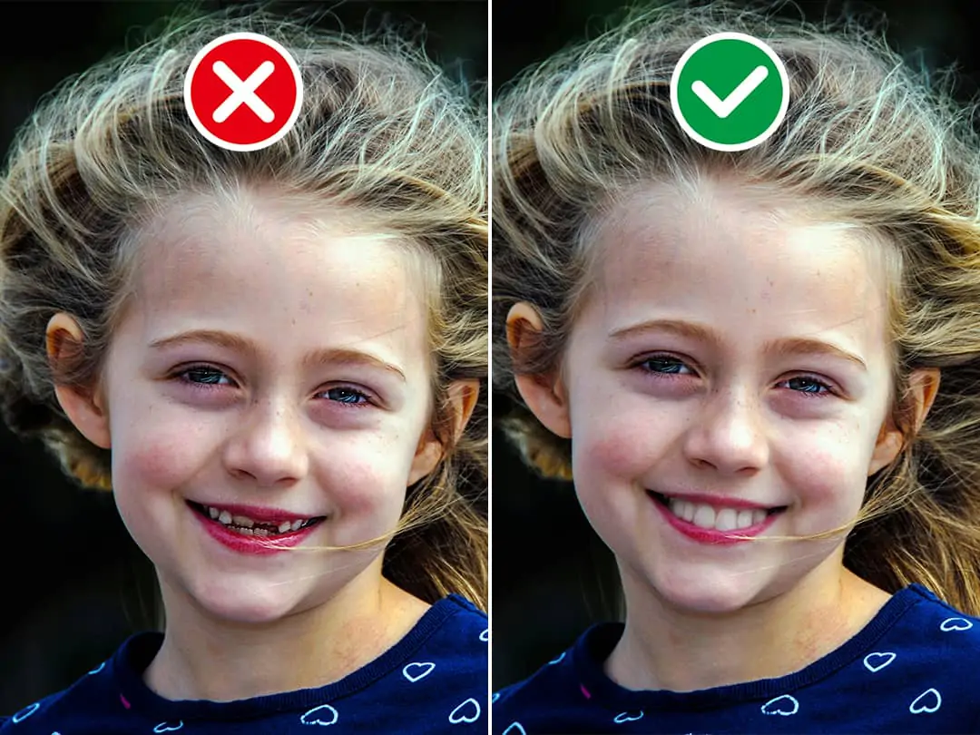 Fix broken teeth for kids